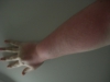 Sonnenbrand